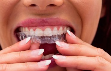 Invisalign