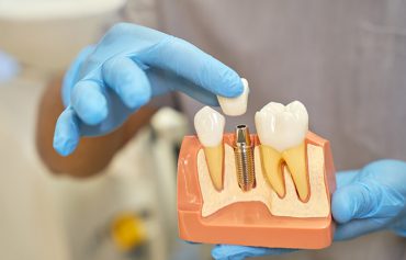 Implante Dentário